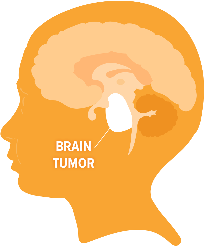 what cancers metastasize to lymph nodes